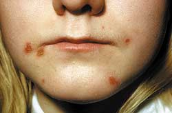 Impetigo