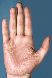 bild på psoriasis i handflata