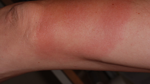 Borrelia (Erythema chronicum migrans)