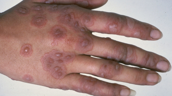 Erythema multiforme