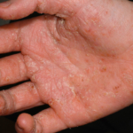 Handeksem –orsak, symtom och behandling