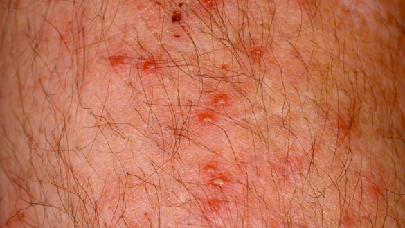 Hårsäcksinflammationer (Follikuliter)