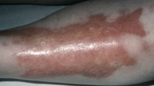 Necrobiosis lipoidica