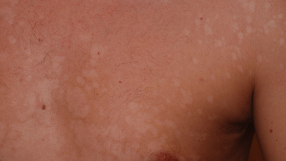 Pityriasis versicolor