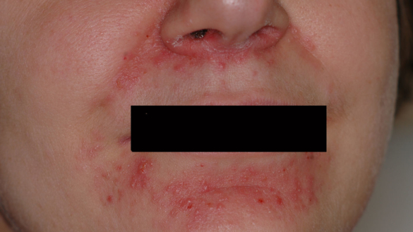 Perioral dermatit