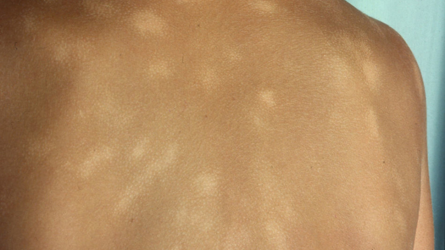 Pityriasis alba