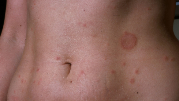 Pityriasis rosea (Medaljongsjuka)