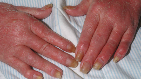 Psoriasisartrit (psoriasisledvärk)