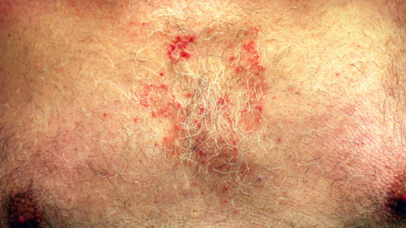 Seborroiskt eksem (mjälleksem)