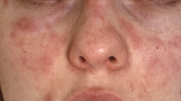 Soleksem och ljuskänslighet