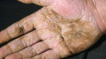 Fissurer och hyperkeratoser i handflata orsakat av tylotiskt eksem