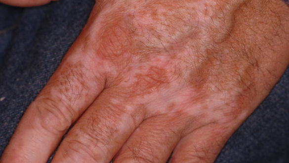 Vitiligo (Pigmentbortfall)