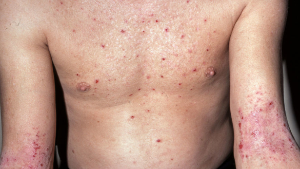 Atopiskt eksem (böjveckseksem): orsak, symtom & behandling