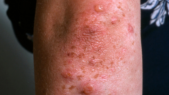 Dermatitis herpetiformis