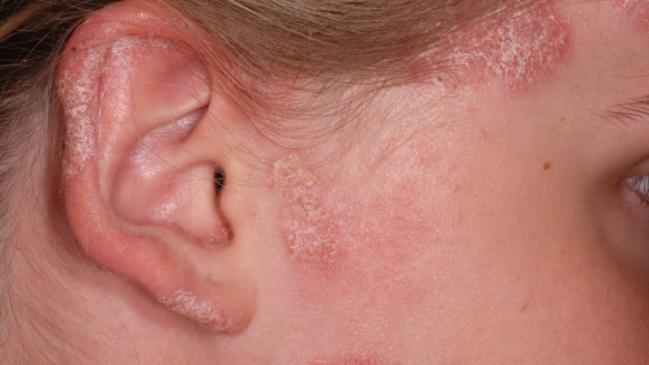 Diskoid Lupus Erythematosus (DLE)