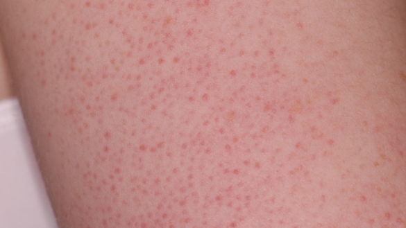 Keratosis pilaris