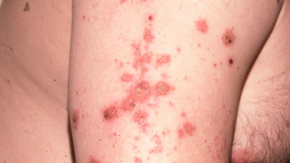 Nummulärt eksem (Mynteksem)