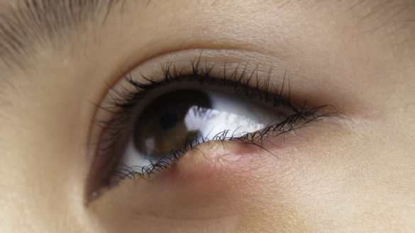 Vagel i ögat – orsak och behandling