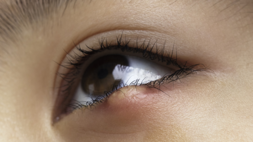 En vagel är en inflammation i ögonlockets kant. Foto: GettyImages