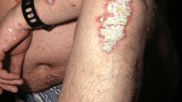 Psoriasis
