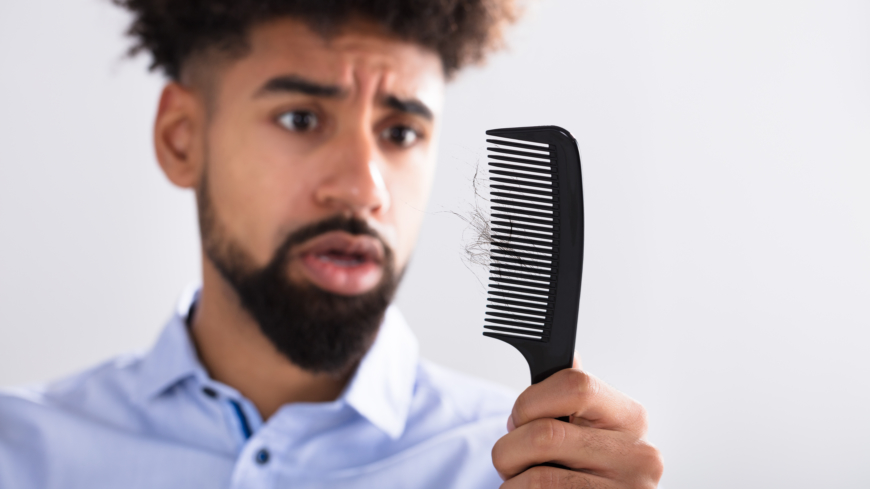 Så kallat manligt håravfall - med fläckar i panna och tunt på hjässan - är ärftligt betingat. Foto: Shutterstock