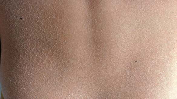 Torr hud: orsak, symtom & behandling