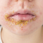 Svinkoppor (Impetigo) – orsak och symtom