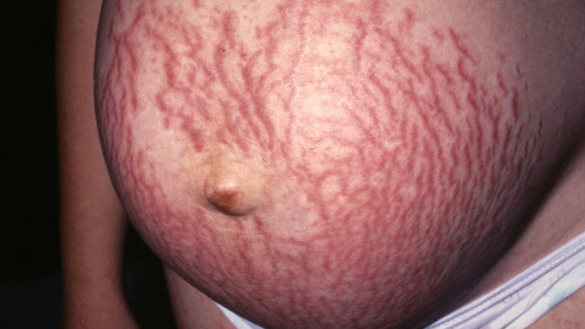 Hudbristningar (Striae)