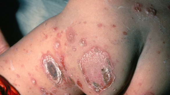 Impetigo (svinkoppor): symtom, förlopp & behandling