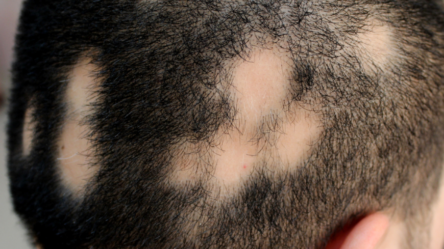  Alopecia areata kännetecknas av fläckvis håravfall på huvudet. Foto: Shutterstock