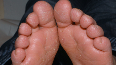 Sprickor i hud på föttera orsakat av atopisk dermatit även kallat vinterfötter