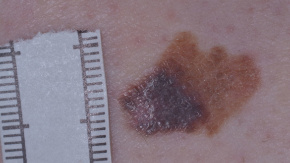 Födelsemärken & Malignt melanom