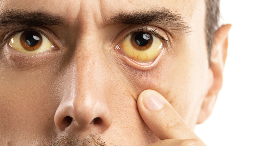 Gula ögonvitor är ett tecken på framskriden skrumplever. Foto: Getty Images