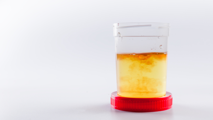 Det finns många anledningar till blod i urinen, till exempel urinvägsinfektion eller njursten. Foto: Getty Images