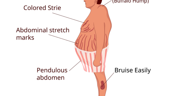 Cushings syndrom (Endogen hyperkortisolism): orsak, symtom & behandling