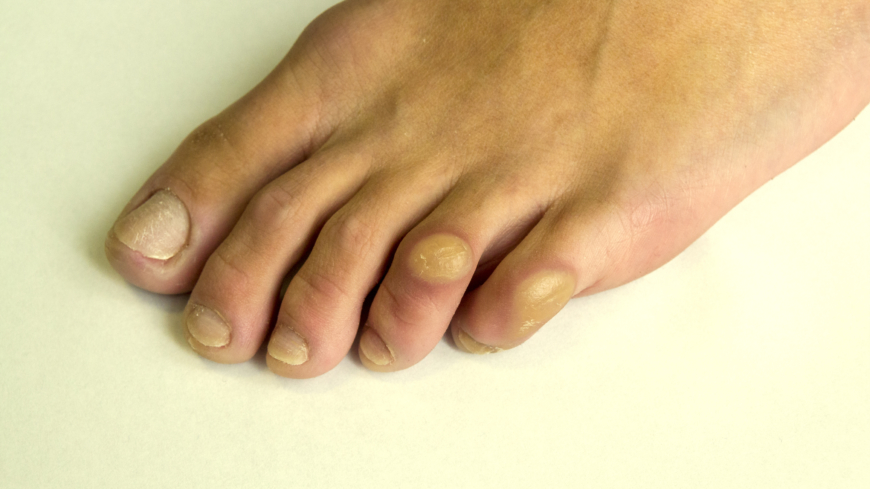 En liktorn uppkommer ofta på grund av obekväma skor, och kan behöva opereras bort. Foto: Getty Images