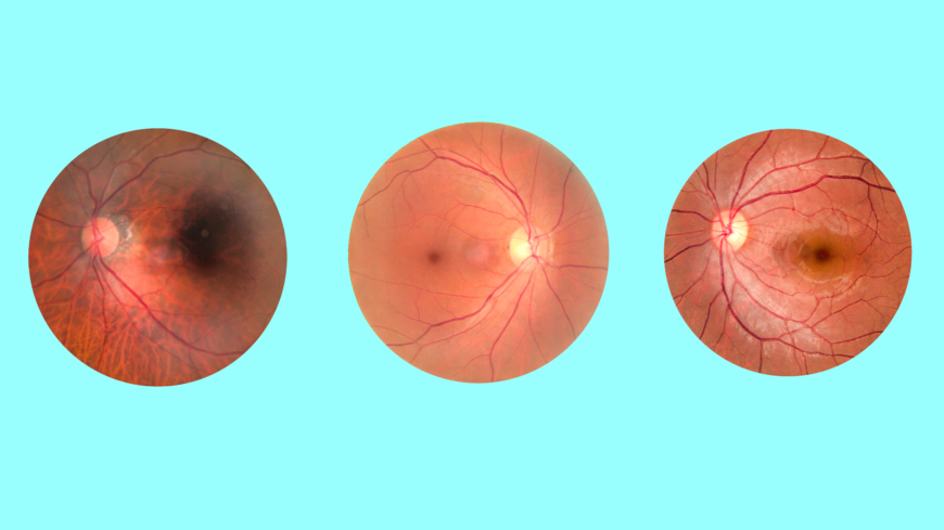 Vid näthinneavlossning undersöker läkaren ögat med ett oftalmoskop, och den avlossade näthinnan ses gråaktig.. Foto: Getty Images