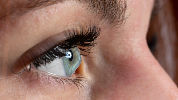 Toppig hornhinna (keratoconus)