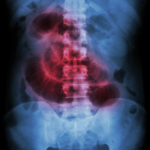 Tarmvred (ileus): orsak, symtom & behandling