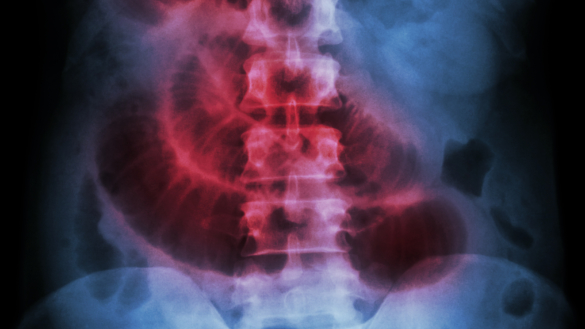Tarmvred (ileus): orsak, symtom & behandling