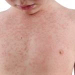 Röda hund (rubella) – du är väl vaccinerad?