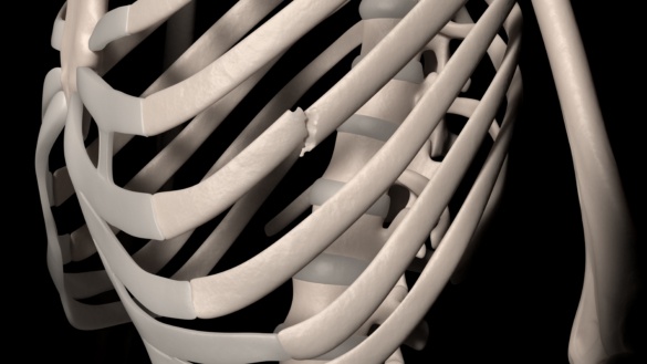 Brutet revben (revbensbrott)