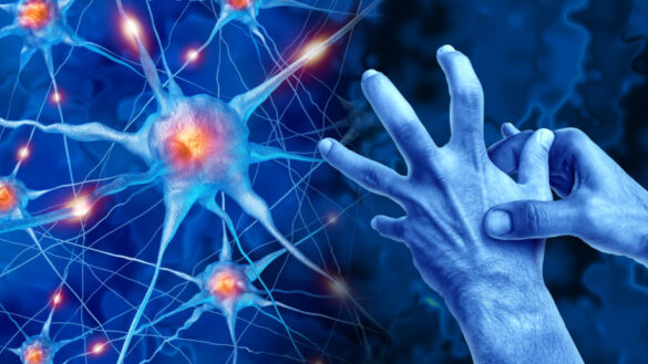 Parkinsons sjukdom: orsak, symtom & behandling