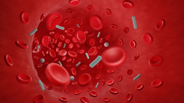 Sepsis (blodförgiftning): symtom, orsaker & behandling