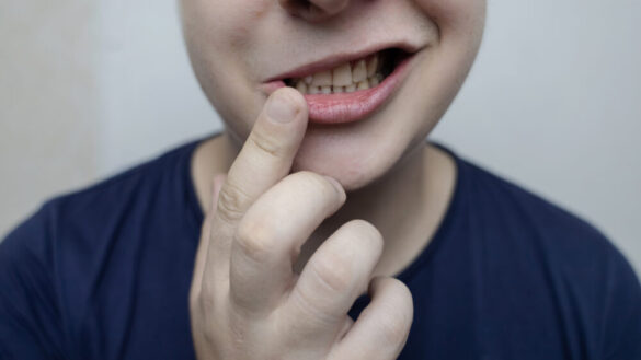 Ansiktsförlamning: symtom, orsak & behandling