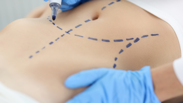 Diabeteskirurgi – behandling vid typ 2-diabetes