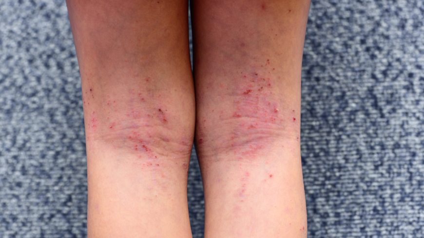 För barn visar sig atopisk dermatit ofta som böjveckseksem och klådan kan vara outhärdlig. Foto: Shutterstock