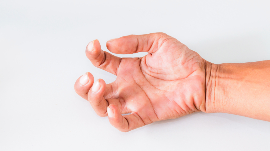 Efter en stroke får många problem med muskelsammandragningar som kan hindra rörelser. Det kan exempelvis vara svårt att sträcka ut fingrarna. Foto: Shutterstock