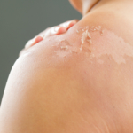 Toxisk epidermal nekrolys (TEN): orsak, symtom & behandling