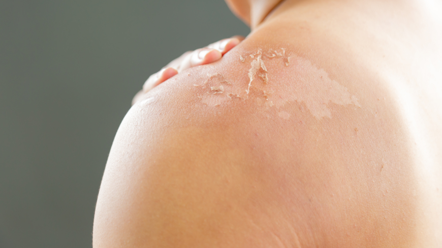 Vid sjukdomen Toxisk epidermal nekrolys får man hudskador på mindre fläckar eller över hela kroppen - det kan liknas vid en brännskada där huden lossnar. Foto: Shutterstock